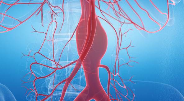 Scalpel-Free Treatment for Brain Aneurysms